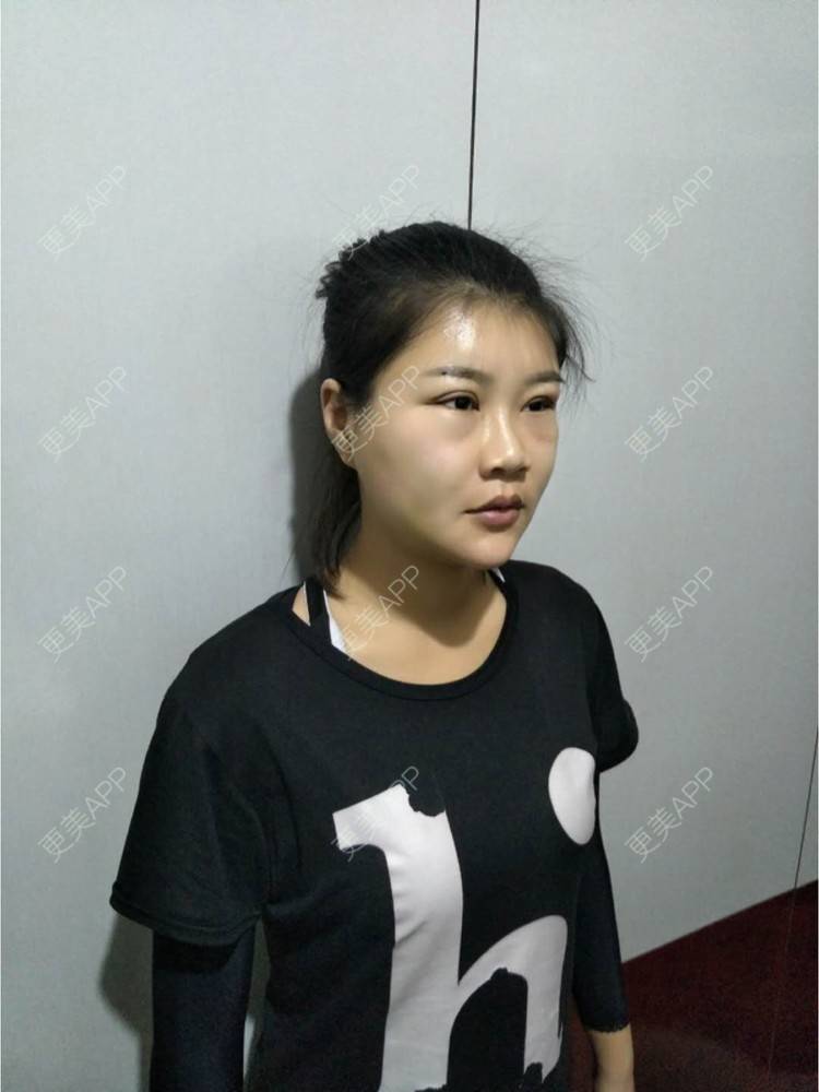 更美 - bug女的经验 | 纳米自体脂肪面部填充 | 重庆