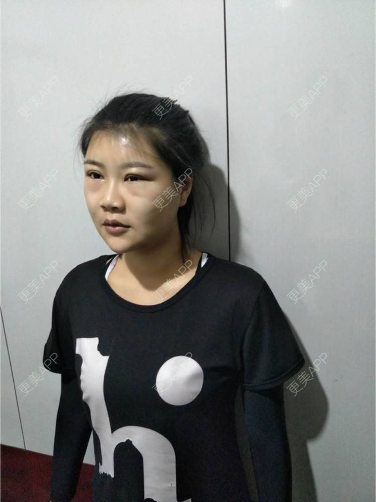 更美 - bug女的经验 | 纳米自体脂肪面部填充 | 重庆