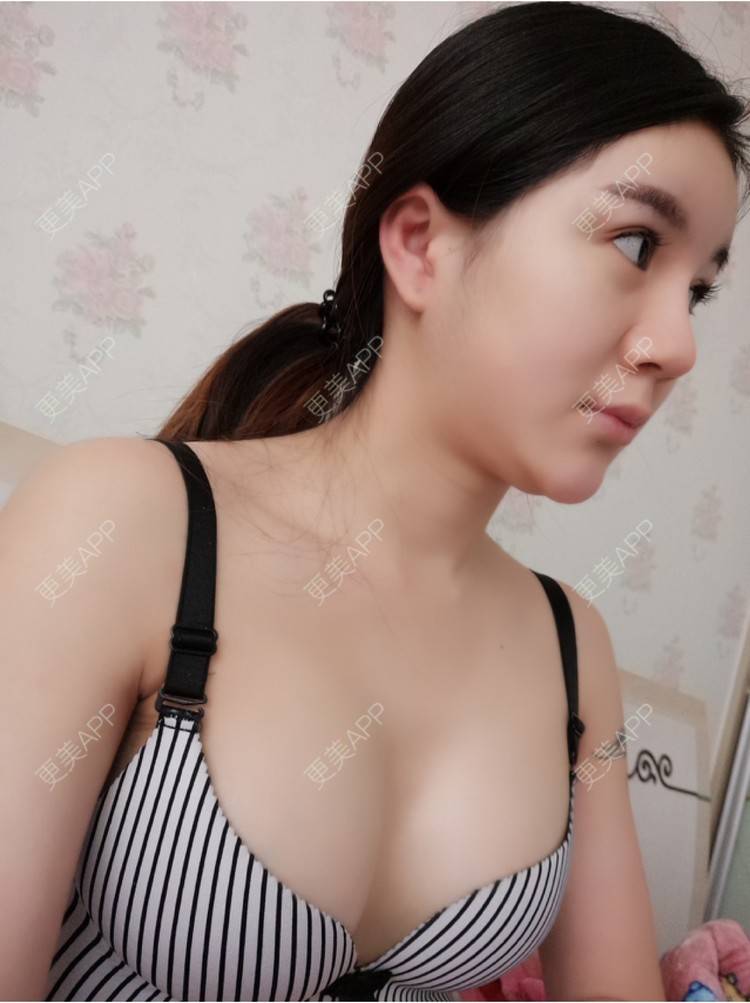 更美 - 白羊杨的假体隆胸经验 | 假体隆胸 | 深v动感丰胸 | 武汉 | 极速丰胸