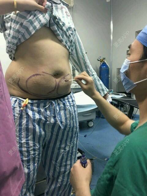 江边的小林的腰腹吸脂日记