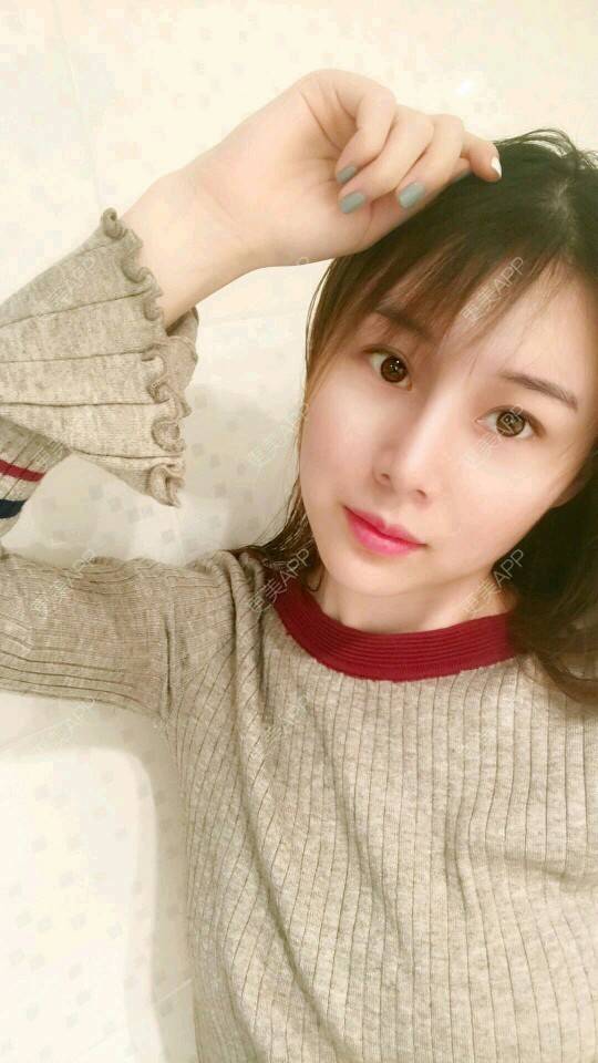 更美 - xNz3B婷的歪鼻矫正经验 | 上海 | 歪鼻矫正