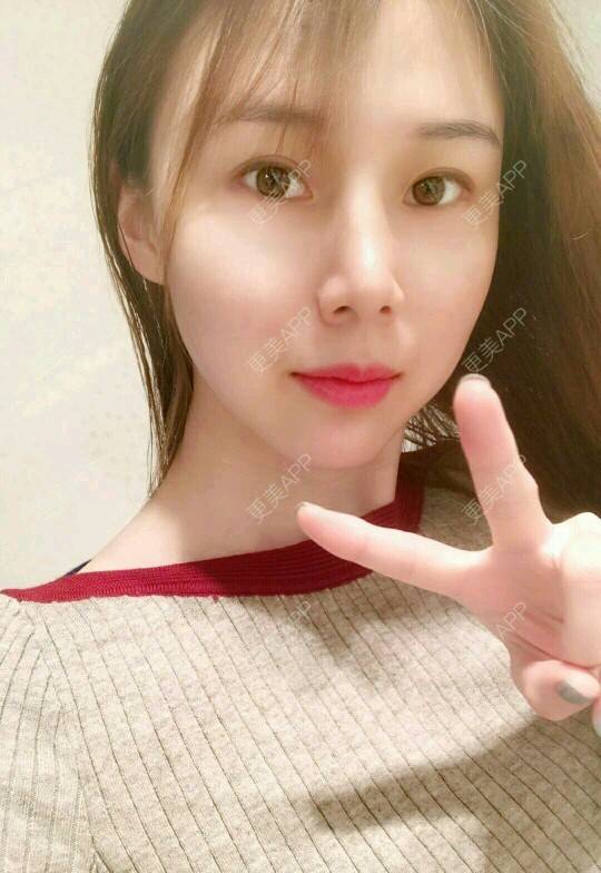 更美 - xNz3B婷的歪鼻矫正经验 | 上海 | 歪鼻矫正