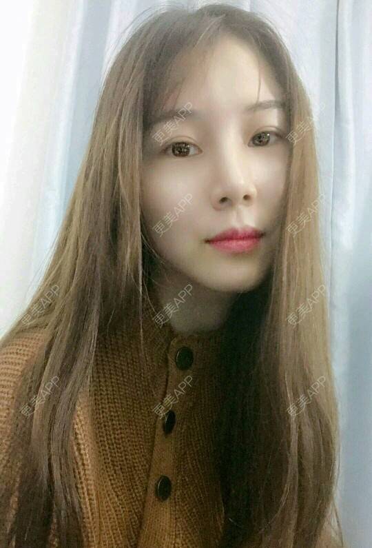 更美 - xNz3B婷的歪鼻矫正经验 | 上海 | 歪鼻矫正
