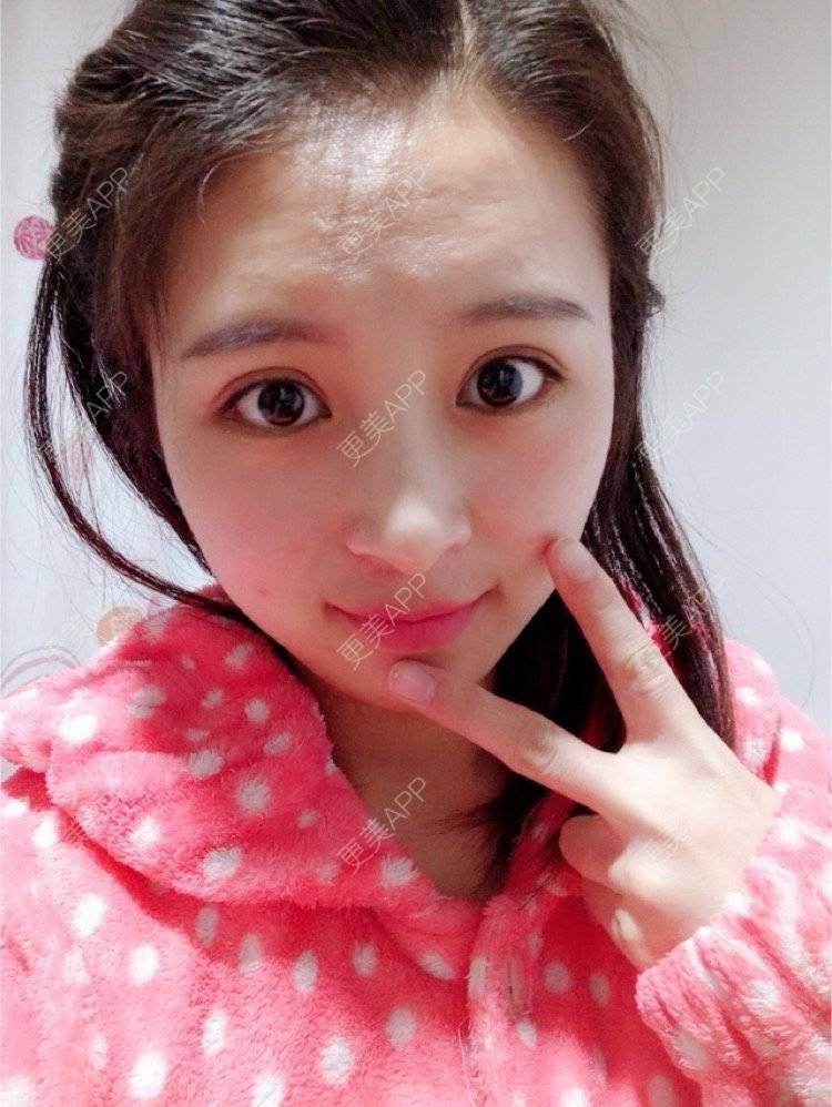 天生小可爱的全切双眼皮日记