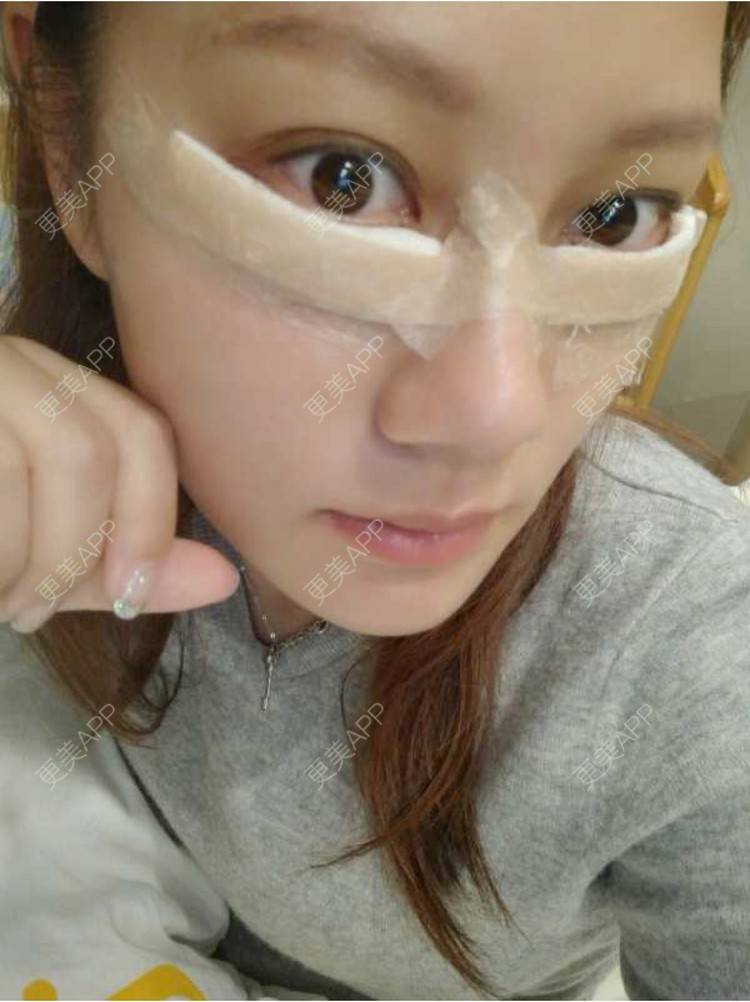 更美 - 玻璃之情的外切去眼袋经验 | 祛眼袋手术 | 外切去眼袋 | 外切眼袋 | 武汉