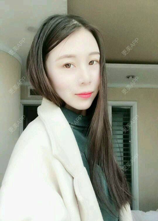更美 - xNz3B婷的歪鼻矫正经验 | 上海 | 歪鼻矫正