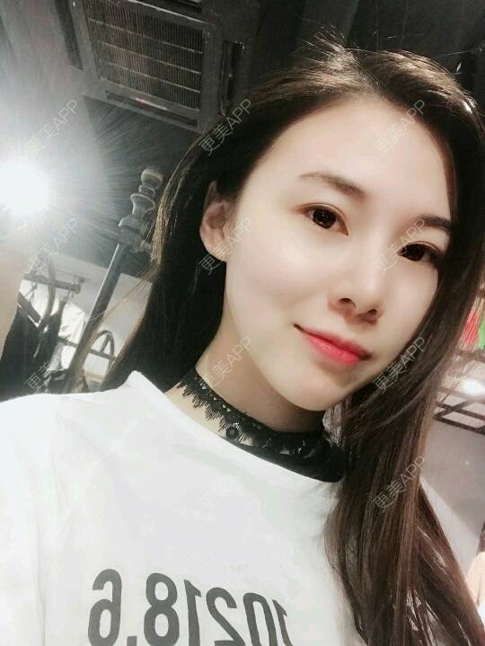 更美 - xNz3B婷的歪鼻矫正经验 | 上海 | 歪鼻矫正