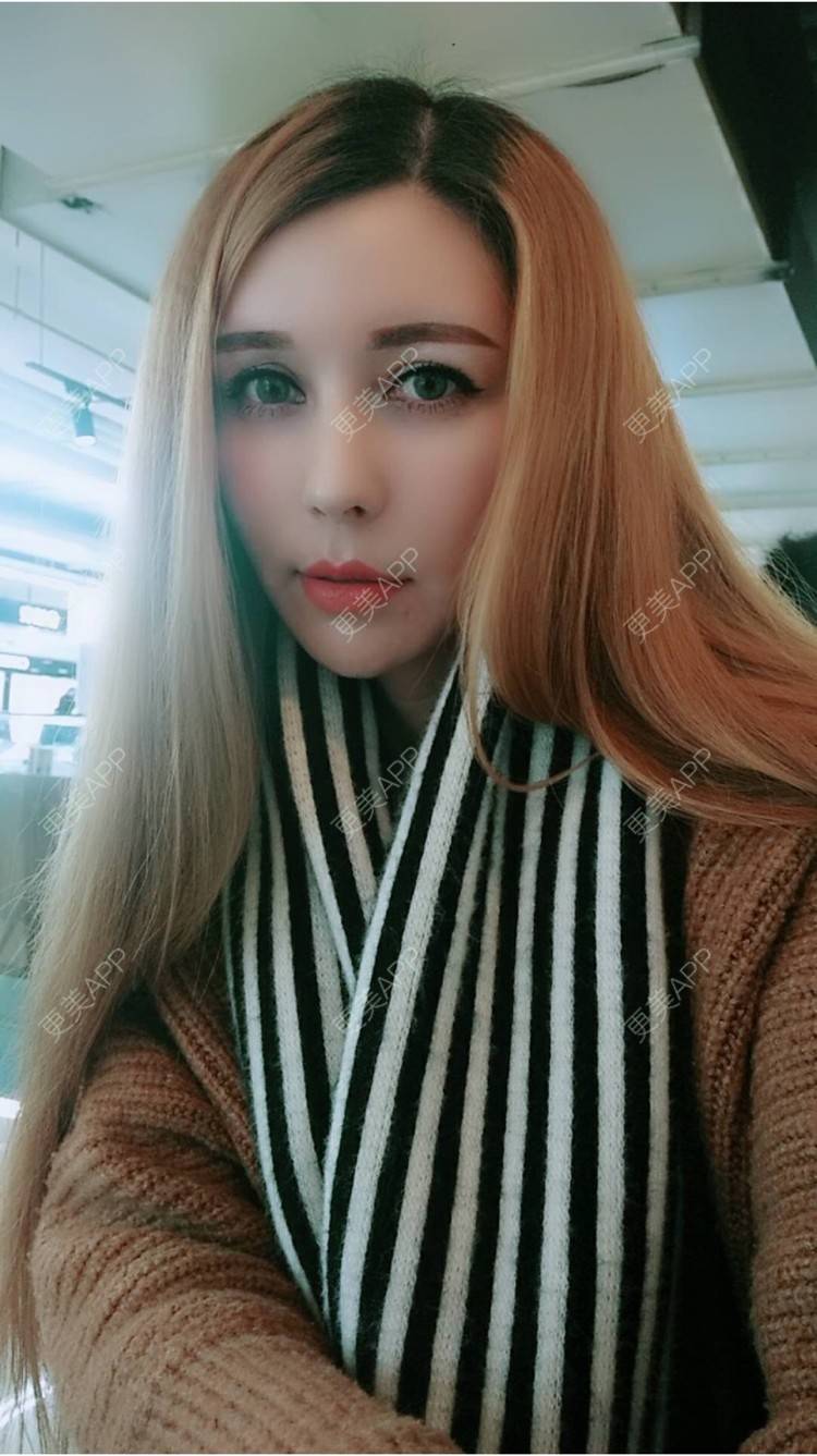 更美 - 菠萝菠萝蜜i的经验 | 纳米自体脂肪面部填充 | 重庆