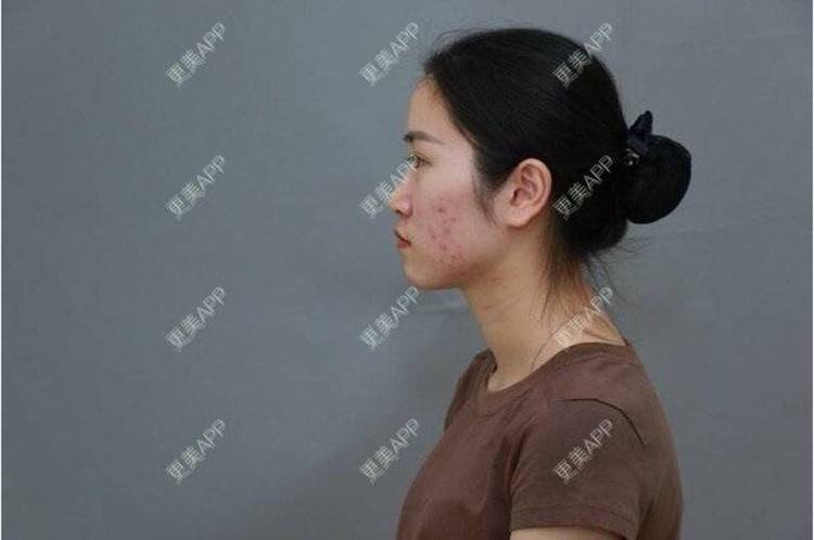 更美 - 班长都很肥的埋线隆鼻经验 | 口腔检查 | 重庆 | 郑州 | 蚌埠 | 唇形 | 硅胶垫下巴 | 隆鼻 | 武汉 | 广州 | 牙贴面 | 埋线隆鼻 | 天津 | 玻尿酸