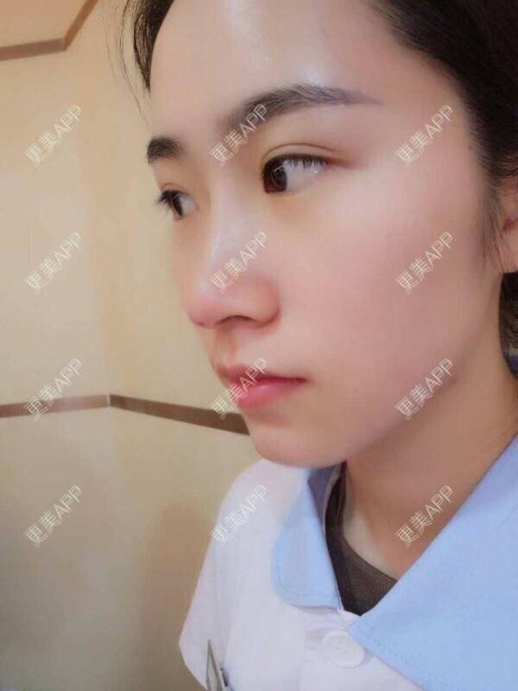 更美 - 班长都很肥的埋线隆鼻经验 | 口腔检查 | 重庆 | 郑州 | 蚌埠 | 唇形 | 硅胶垫下巴 | 隆鼻 | 武汉 | 广州 | 牙贴面 | 埋线隆鼻 | 天津 | 玻尿酸