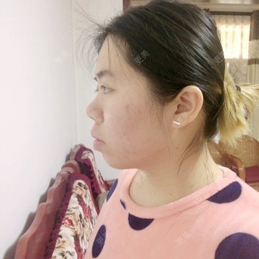 嘴巴外凸下巴后缩侧面好丑哦不懂该怎么办
