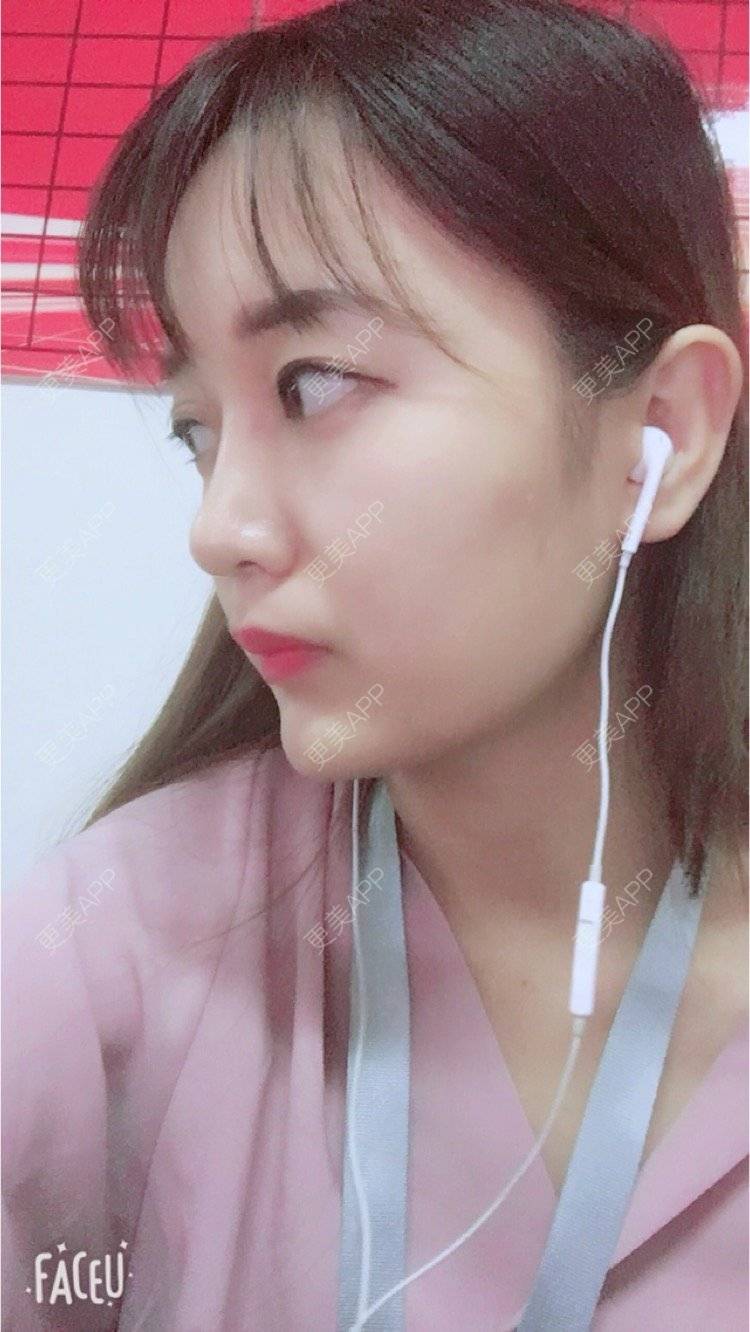更美 - 匆匆1108的全脸整形套餐经验 | 鼻部整形 | 全脸整形套餐 | 武汉 | 隆鼻