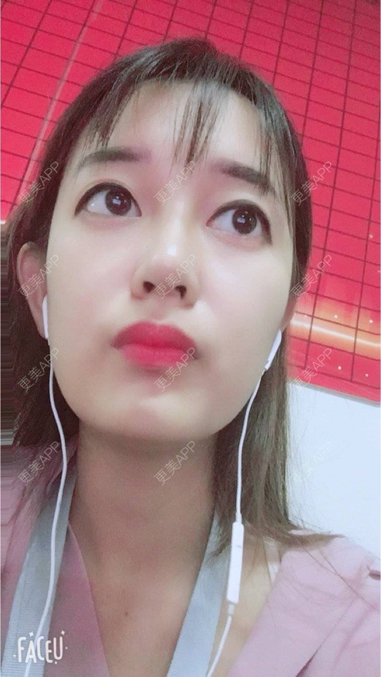 更美 - 匆匆1108的全脸整形套餐经验 | 鼻部整形 | 全脸整形套餐 | 武汉 | 隆鼻