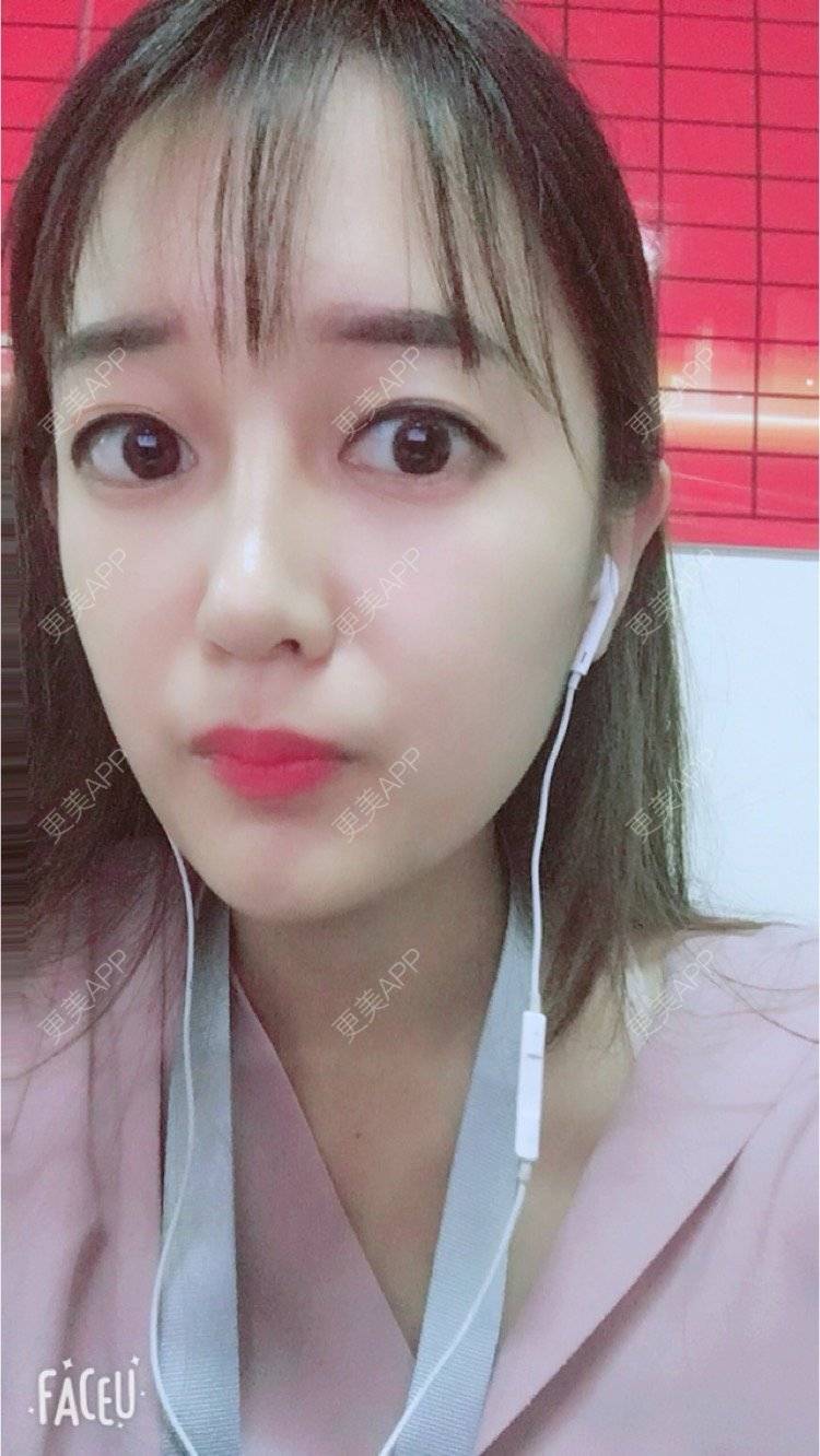 更美 - 匆匆1108的全脸整形套餐经验 | 鼻部整形 | 全脸整形套餐 | 武汉 | 隆鼻