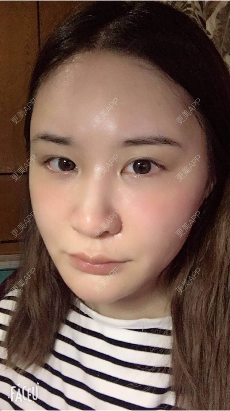 更美 - 婷逗比的经验 | 纳米自体脂肪面部填充 | 重庆