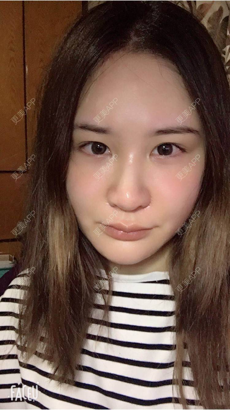 更美 - 婷逗比的经验 | 纳米自体脂肪面部填充 | 重庆