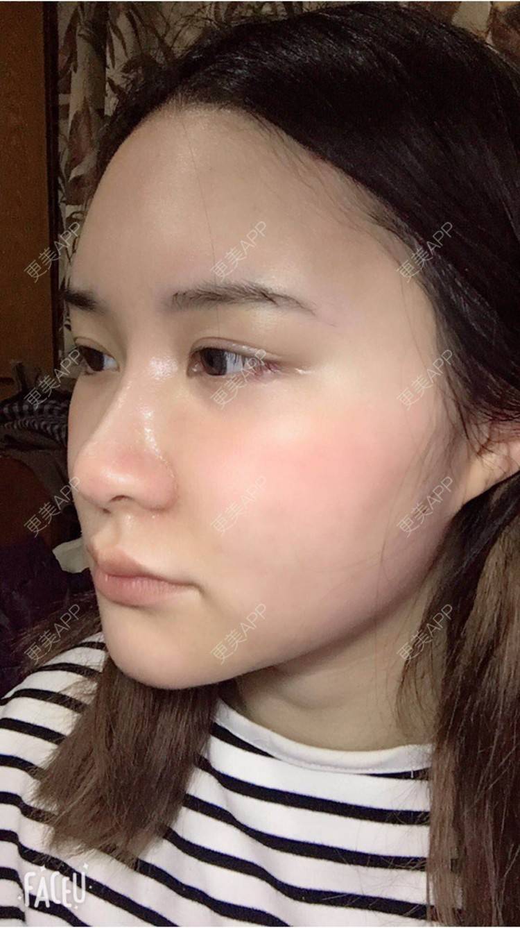 更美 - 婷逗比的经验 | 纳米自体脂肪面部填充 | 重庆