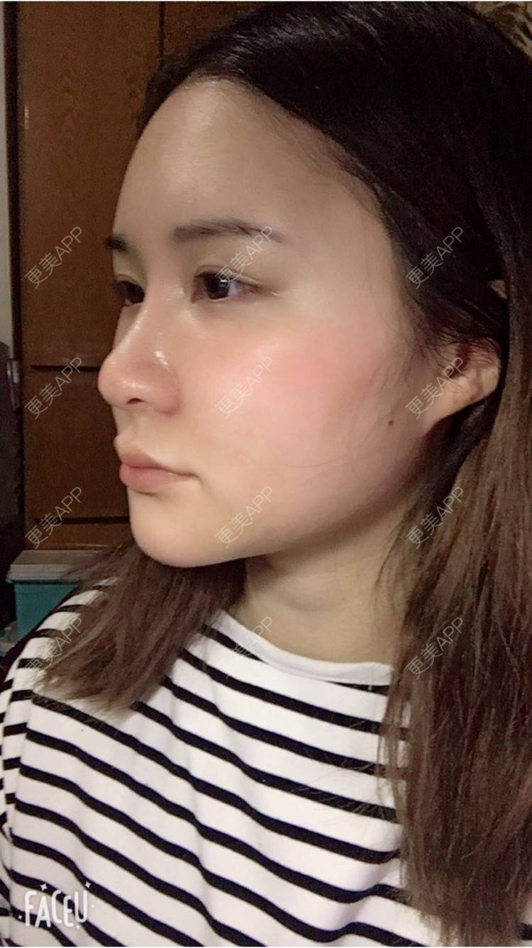 更美 - 婷逗比的经验 | 纳米自体脂肪面部填充 | 重庆