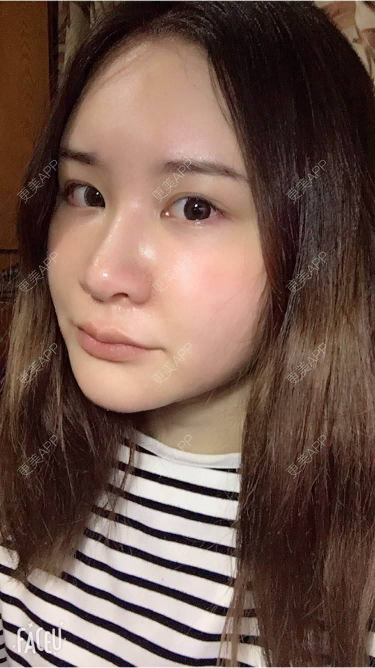 更美 - 婷逗比的经验 | 纳米自体脂肪面部填充 | 重庆