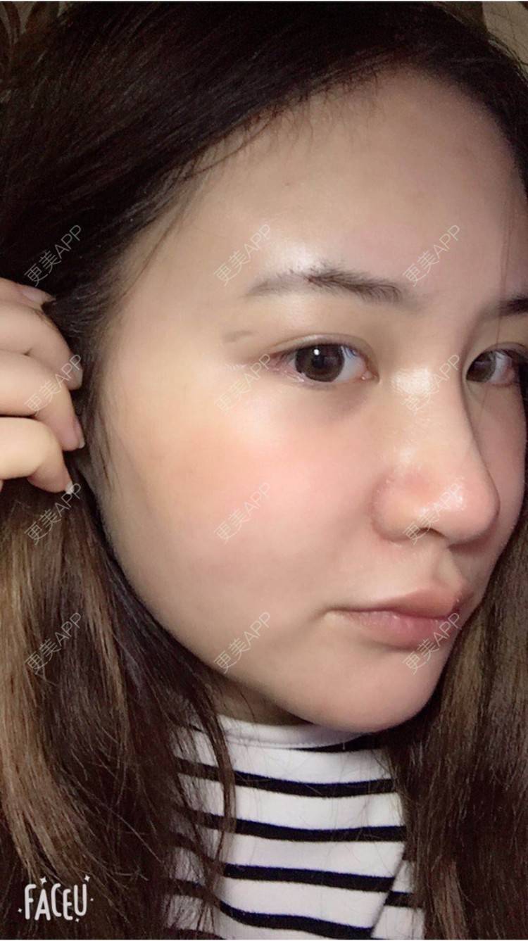 更美 - 婷逗比的经验 | 纳米自体脂肪面部填充 | 重庆