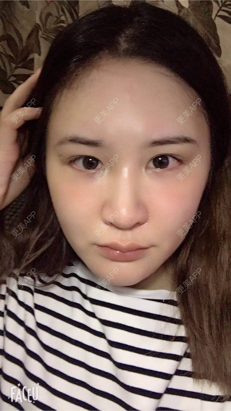 更美 - 婷逗比的经验 | 纳米自体脂肪面部填充 | 重庆