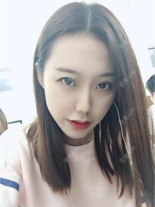 更美 - 一颗如如果的玻尿酸唇部经验 | 玻尿酸价格 | 玻尿酸唇部 | 注射美容 | 重庆