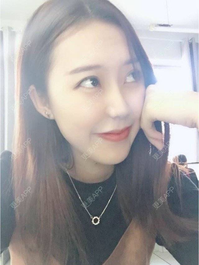 更美 - 一颗如如果的玻尿酸唇部经验 | 玻尿酸价格 | 玻尿酸唇部 | 注射美容 | 重庆