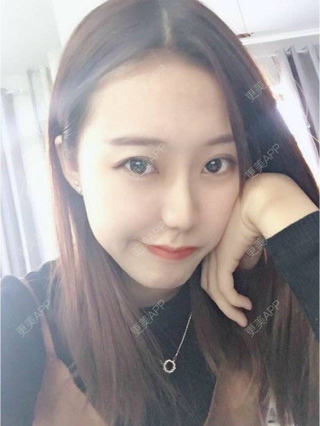 更美 - 一颗如如果的玻尿酸唇部经验 | 玻尿酸价格 | 玻尿酸唇部 | 注射美容 | 重庆