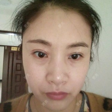 自体脂肪填充泪沟