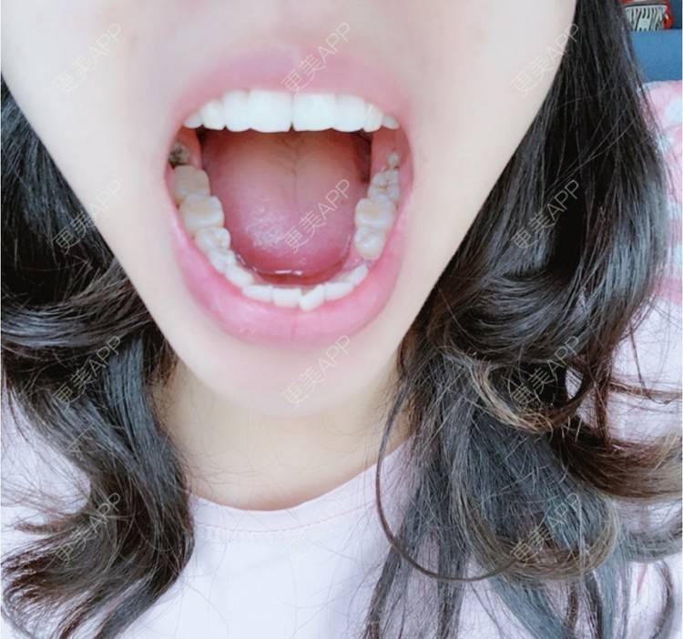 更美 - 么么哒柔的玻尿酸经验 | 广州 | 矫正牙齿 | 视频日记 | 玻尿酸