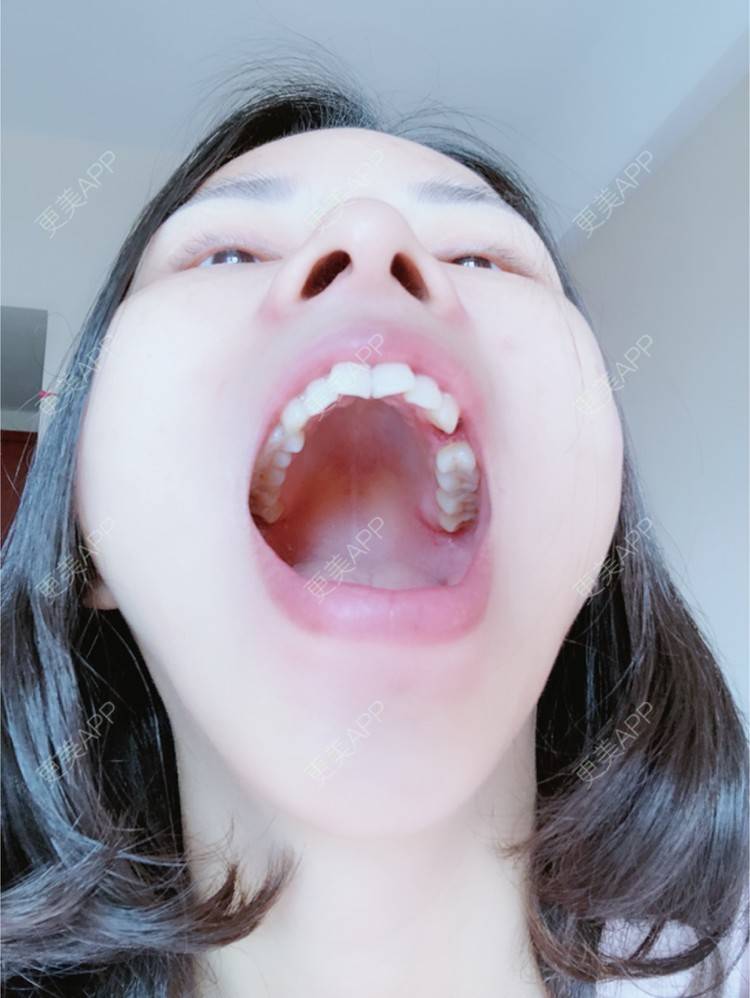 更美 - 么么哒柔的玻尿酸经验 | 广州 | 矫正牙齿 | 视频日记 | 玻尿酸