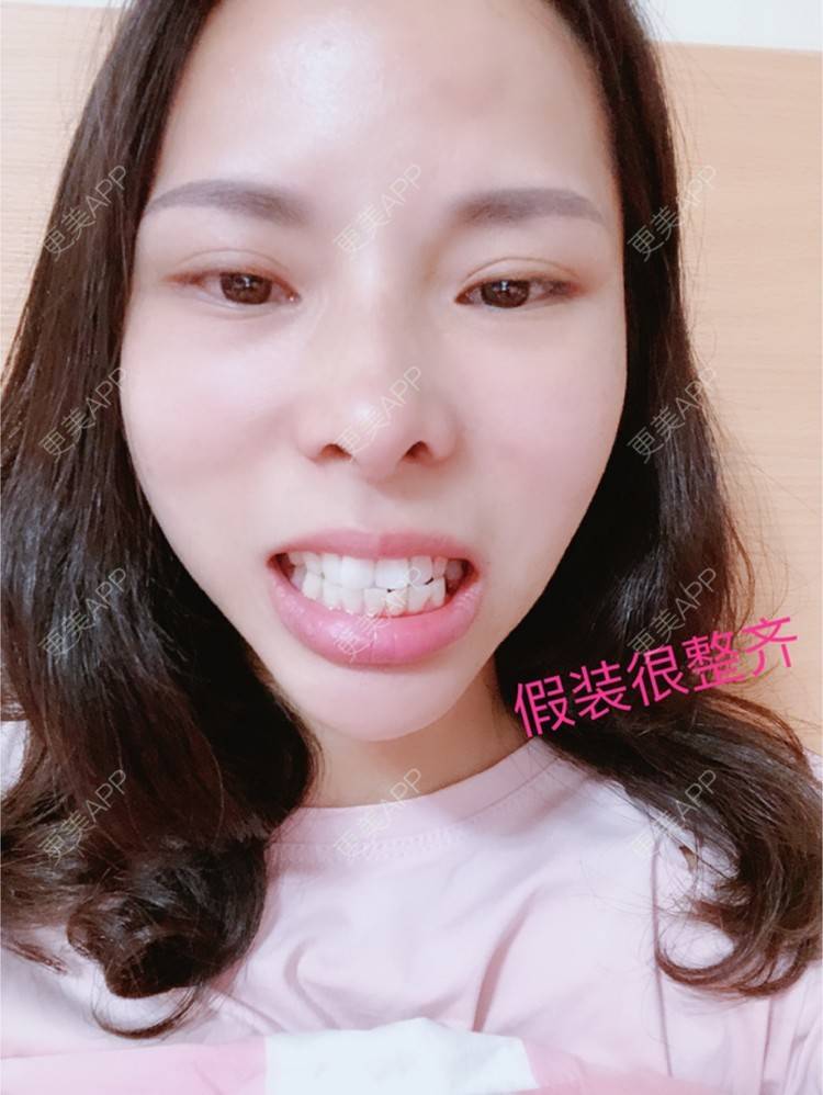 更美 - 么么哒柔的玻尿酸经验 | 广州 | 矫正牙齿 | 视频日记 | 玻尿酸