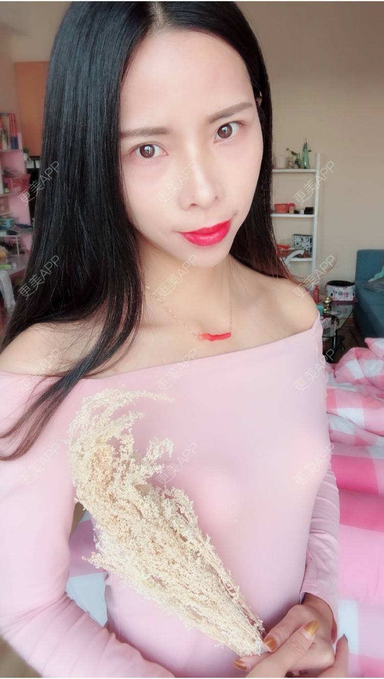 更美 - 么么哒柔的玻尿酸经验 | 广州 | 矫正牙齿 | 视频日记 | 玻尿酸