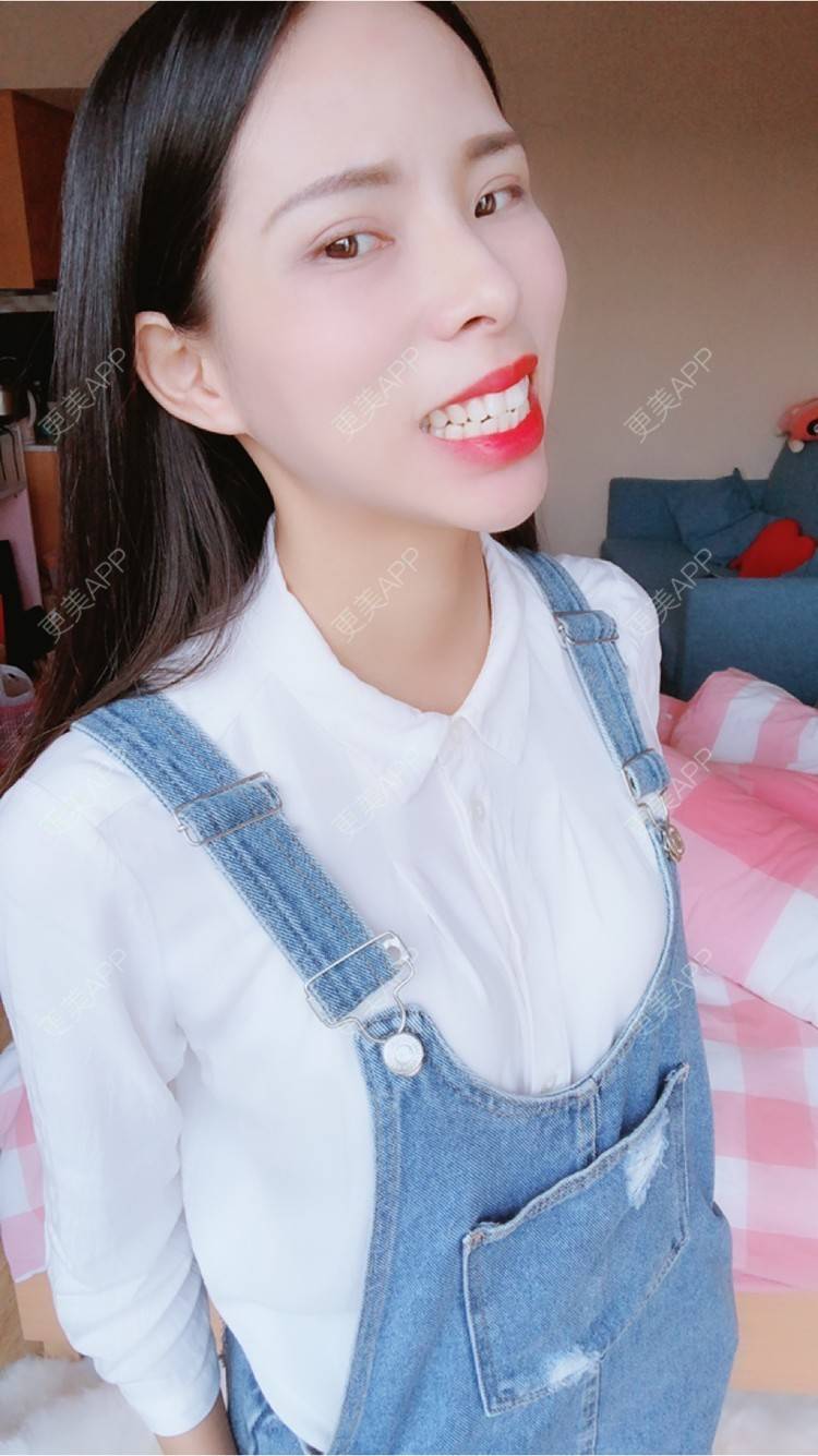 更美 - 么么哒柔的玻尿酸经验 | 广州 | 矫正牙齿 | 视频日记 | 玻尿酸