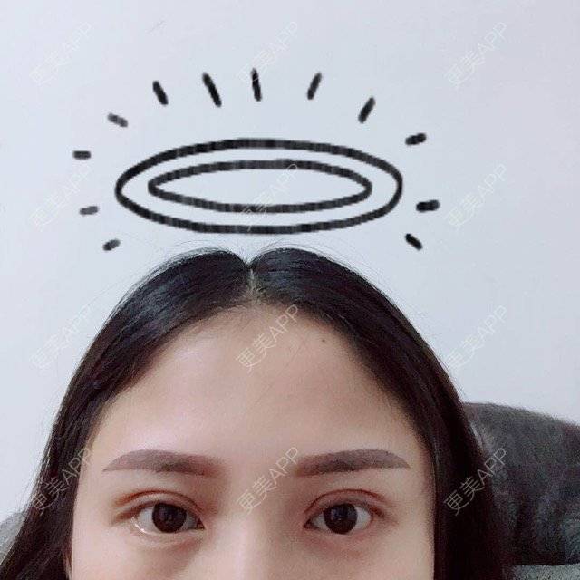 更美 - all丶的眼部多项经验 | 是否要开内眼角 | 长沙 | 双眼皮 | 眼部多项