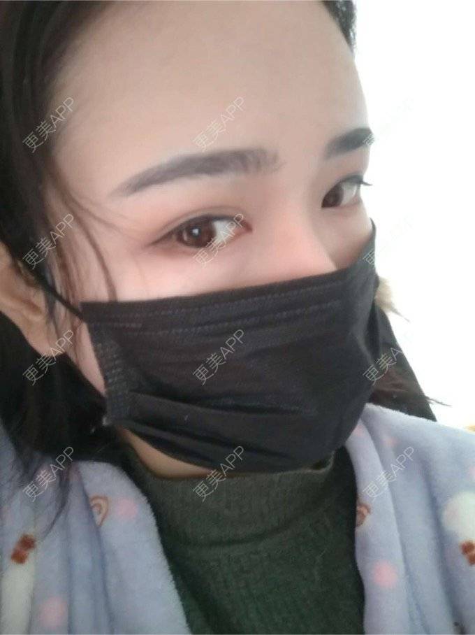 更美 - 平和哦的自体脂肪丰额头经验 | 自体脂肪丰额头 | 合肥