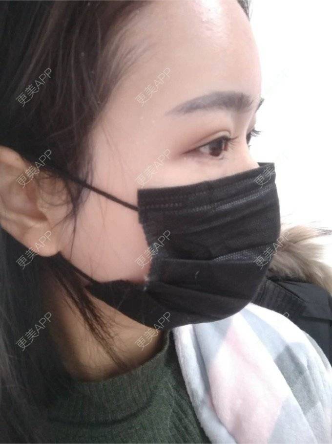 更美 - 平和哦的自体脂肪丰额头经验 | 自体脂肪丰额头 | 合肥