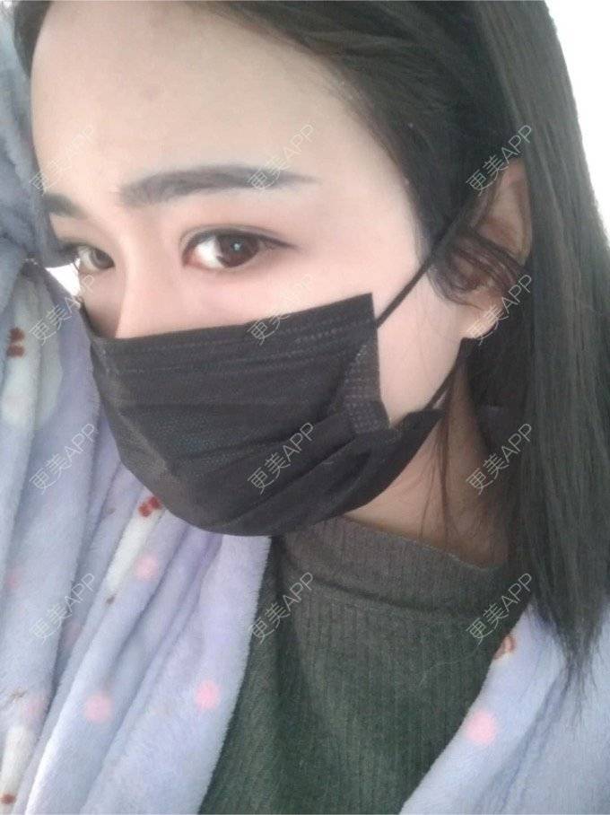 更美 - 平和哦的自体脂肪丰额头经验 | 自体脂肪丰额头 | 合肥