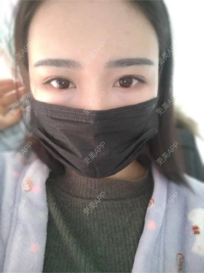 更美 - 平和哦的自体脂肪丰额头经验 | 自体脂肪丰额头 | 合肥