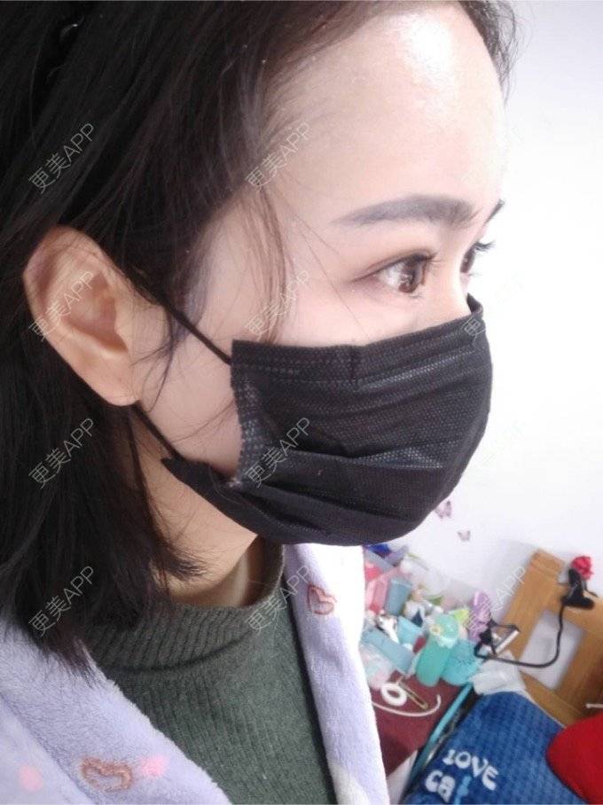 更美 - 平和哦的自体脂肪丰额头经验 | 自体脂肪丰额头 | 合肥