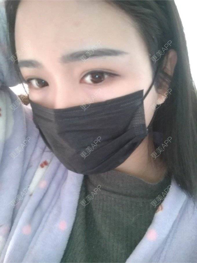 更美 - 平和哦的自体脂肪丰额头经验 | 自体脂肪丰额头 | 合肥