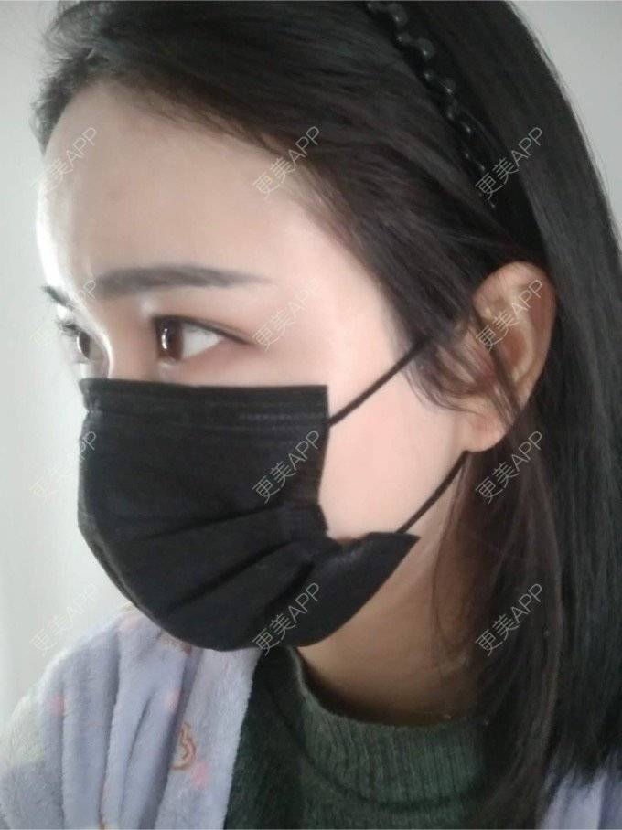 更美 - 平和哦的自体脂肪丰额头经验 | 自体脂肪丰额头 | 合肥