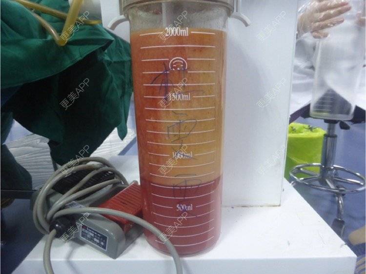 更美 - 平和哦的自体脂肪丰额头经验 | 自体脂肪丰额头 | 合肥