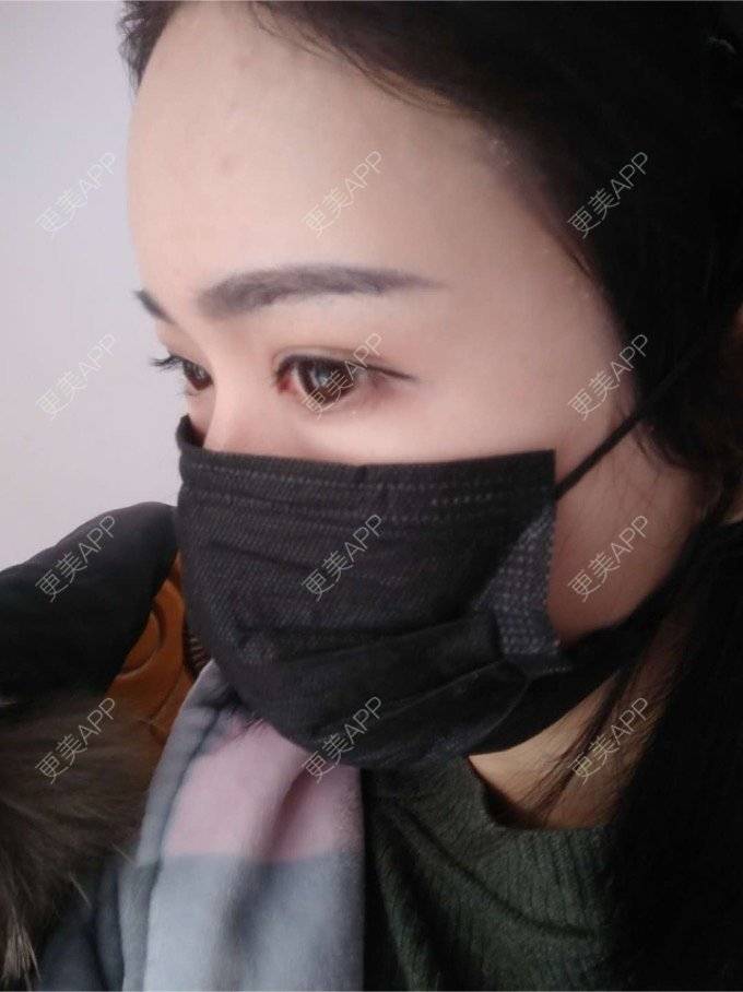 更美 - 平和哦的自体脂肪丰额头经验 | 自体脂肪丰额头 | 合肥