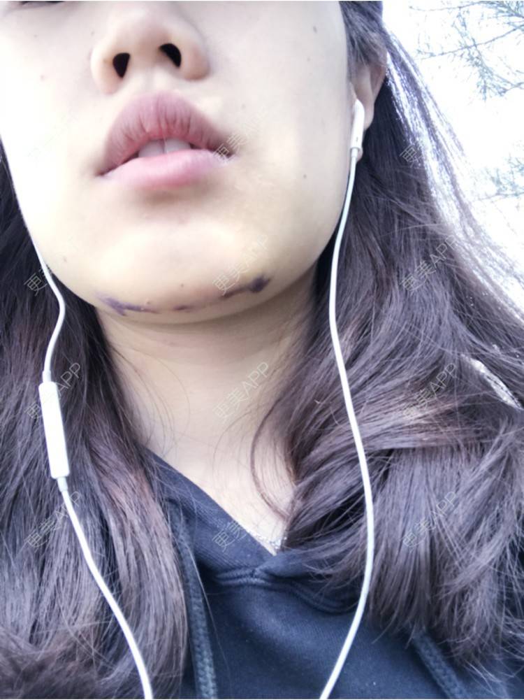 分享到:下巴效果图推荐商品【硅胶垫下巴】硅胶垫下巴 康宁硅胶假体垫