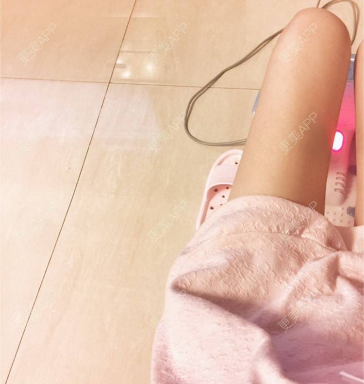 更美 - luna正正的吸脂日记 | 自体脂肪全脸填充 | 吸脂 | 吸脂瘦大腿