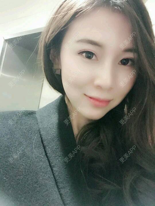 更美 - xNz3B婷的歪鼻矫正经验 | 上海 | 歪鼻矫正