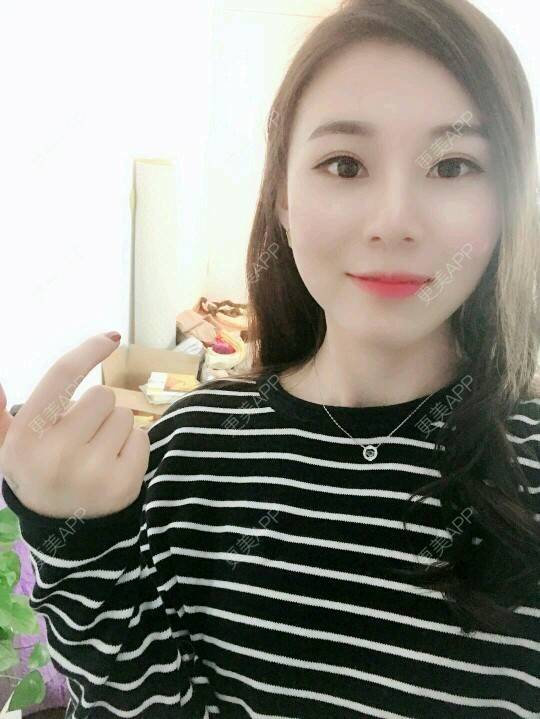 更美 - xNz3B婷的歪鼻矫正经验 | 上海 | 歪鼻矫正