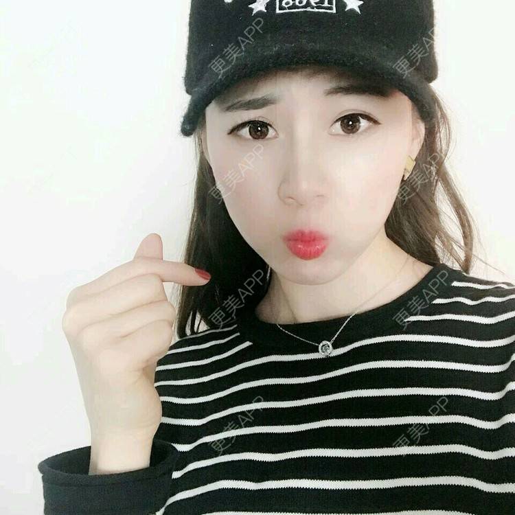 更美 - xNz3B婷的歪鼻矫正经验 | 上海 | 歪鼻矫正