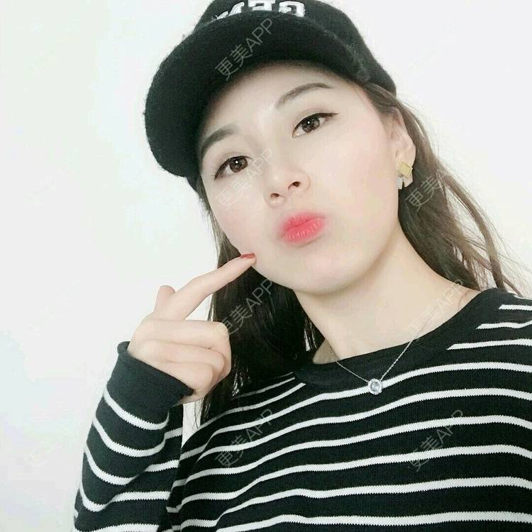 更美 - xNz3B婷的歪鼻矫正经验 | 上海 | 歪鼻矫正